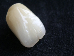 Vollkeramische Versorgungen